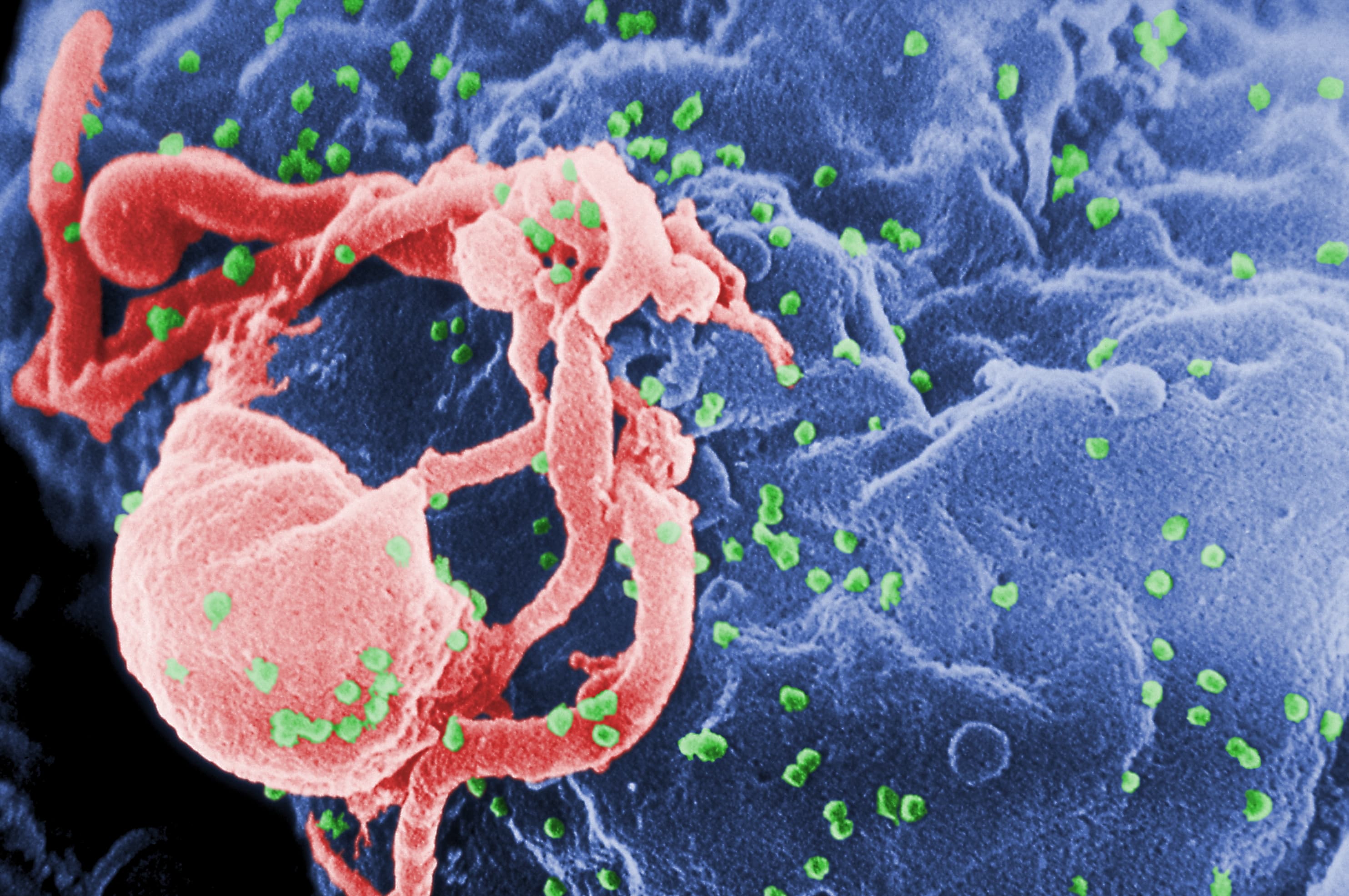 HIV Resistance and Treatment Advances