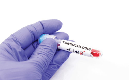 Improving Tuberculosis Testing Infrastructure